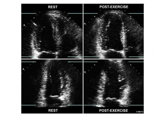Figure 1 from the new ASE ischemia cardiac ultrasound imaging guidelines, showing a side-by-side views of apical 4- and 2-chamber images, at rest and immediately post-exercise. In the four-chamber view, the left ventricle is shown on the left-hand side of the screen. With exercise, the echocardiogram shows the LV cavity dilates (right quadrants) and there are regional wall motion abnormalities in the LAD territory. 