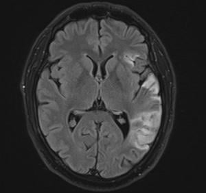 Researchers Develop Automated MRI System to Strengthen Stroke Treatment Studies