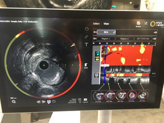 NIRS-IVUS Detects Patients and Plaques Vulnerable to Subsequent Adverse Coronary Events