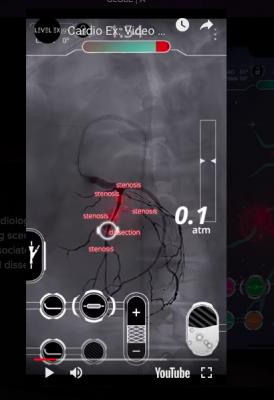 The Cardio Ex cath lab app-based video game for physician training, showing an angiographic view of the coronary arteries with various vascular issues, including stenosis and a dissection.