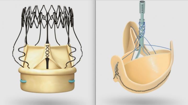 The LivaNova Percelval sutureless aortic valve and Solo Smart surgical aortic valve are part of heart valve portfolio the company sold off June 1 to Gyrus Capital and Corcym..