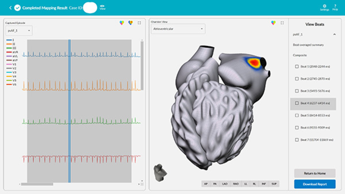 A new way of treating arrhythmias, including atrial fibrillation (AF) — the most common heart arrhythmia diagnosis in clinical practice — has debuted at UC San Diego Health. vMap is a non-invasive, computational mapping system that produces a three-dimensional, interactive map of arrhythmia hotspots anywhere in the heart, including all four chambers of the organ, the septal wall and the outflow tracts. 