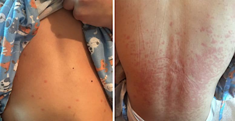 Exantham on abdomen and back of a pediatric patient at Nemours Children’s Health System in Delaware who presented with mysterious symptoms in what would later be identified as one of the first cases of multisystem inflammatory syndrome in children (MIS-C) in the United States.