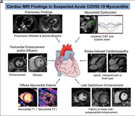 COVID-19 Linked to Heart Inflammation in College Athletes late-breaking study at RSNA 2021.