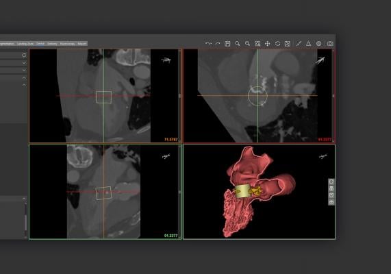 Materialise Receives FDA Clearance for Cardiovascular Planning Software Suite