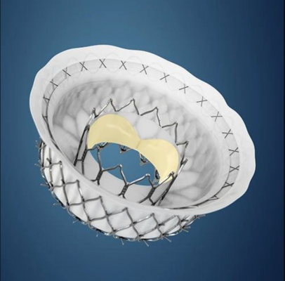 Medtronic Apollo Intrepid TMVR is currently in the middle of a U.S. clinical trial. #TCT #TCT21 #TMVR