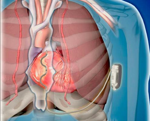 A first-in-human pilot study of Medtronic's investigational Extravascular Implantable Cardioverter Defibrillator (EV ICD) system showed it can be implanted with no major complications, and can sense, pace and defibrillate the heart.