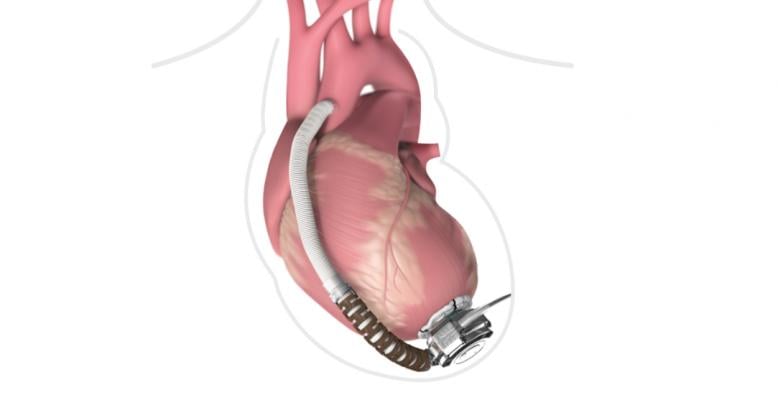 FDA Class I Recall Issued for Medtronic HeartWare HVAD Pump