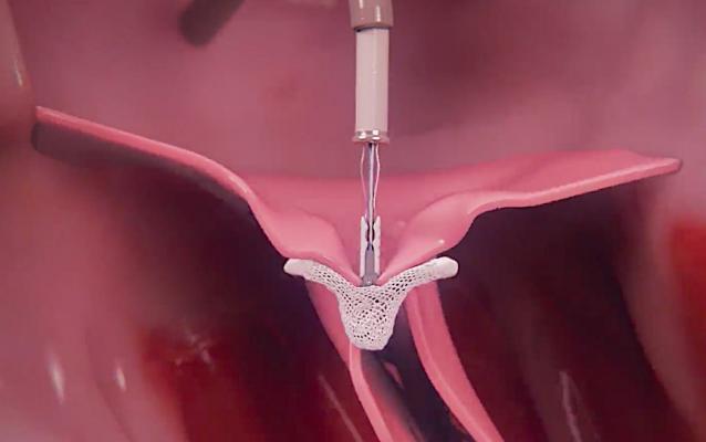 A new CMS national coverage determination for reimbursement for MitraClip significantly expand access to transcatheter mitral valve repair procedures for secondary mitral regurgitation.