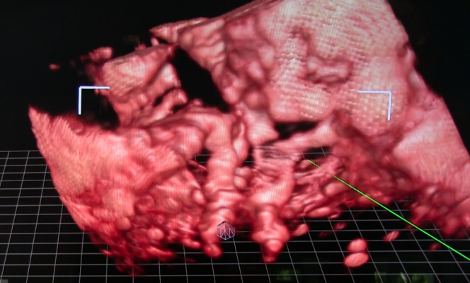 3D TEE, Mitraclip, mitraclip implantation, Echopixel, GE Healthcare, 3D imaging for procedural navigation