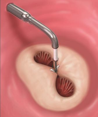 A MitraClip device being deployed to clasp together the leaflets of the mitral valve. This mimics a surgical suture repair to create a double orifice valve with better leaflet coaptation to prevent mitral regurgitation. Abbott Mitraclip device.