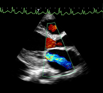 Mitral Valve regurgitation showed on an echocardiogram, cardiac ultrasound
