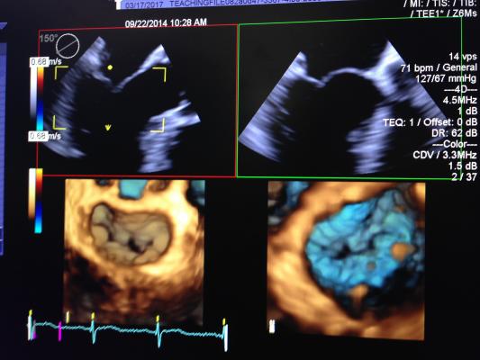 Earlier Intervention for Mitral Valve Disease May Lead to Improved Outcomes