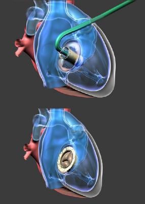 Gate Bioprosthesis Used in Canada's First Transcatheter Valve Replacement for Tricuspid Regurgitation