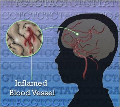 NIH Cardiac Diagnostics Genetic Disorder Strokes Vascular Inflammation Children