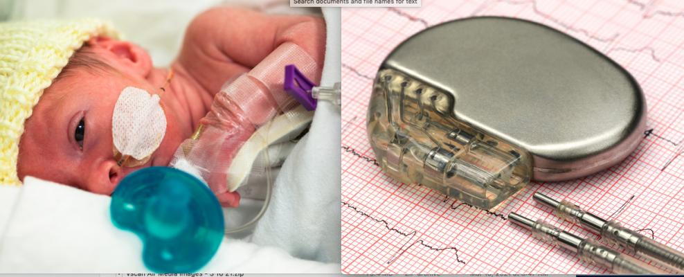 Neonates and young pediatric patients with congenital heart disease have few options for implantable electrophysiology (EP) devices like pacemakers or ICDs.