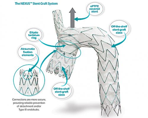 The Endospan Ltd. Nexus aortic arch stent graft is a CE mark–approved, off-the-shelf system for endovascular treatment of pathologies extending or involving the aortic arch.  #VIVA19 #VIVA2019