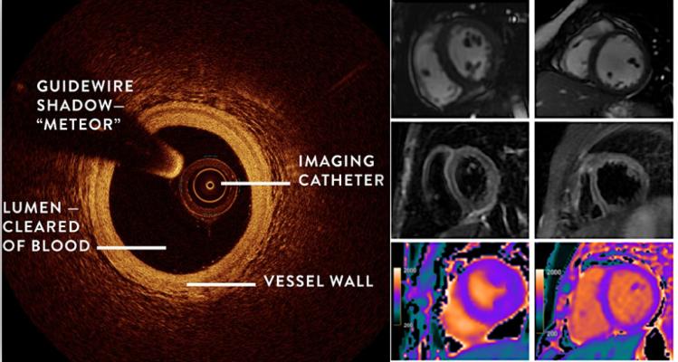 Women’s Heart Attack Research Program (HARP) shows combining OCT and cardiac MRI can detect the underlying cause of heart attack in women who did not have blocked arteries