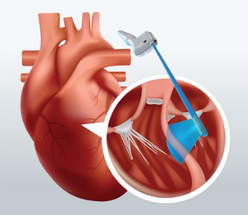 Provides real-time visualization and guidance for measuring ventricular septal thickness during septal myectomy surgery 