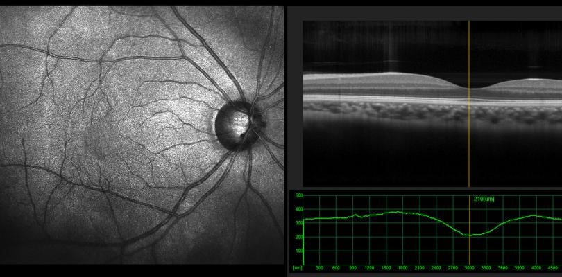 Ophthalmic optical coherence tomography (OCT) scan view of the macula in retina with vessels. Detecting heart disease with OCT imaging of the eye.Getty Images