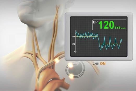 The Orchestra BioMed BackBeat Cardiac Neuromodulation Therapy (CNT) system is implanted similar to a pacemaker to stimulate the sympathetic nerves to help reduce blood pressure.