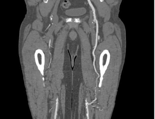 A peripheral artery disease (PAD) patient CT scan showing blockages in the femoral arteries in the legs with collateral flow in the leg on the right.