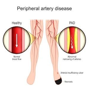 Study: Adherence to GDC Reduced Risk of Serious Limb Events at Two Years