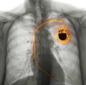 Pacemaker, Afib, ai