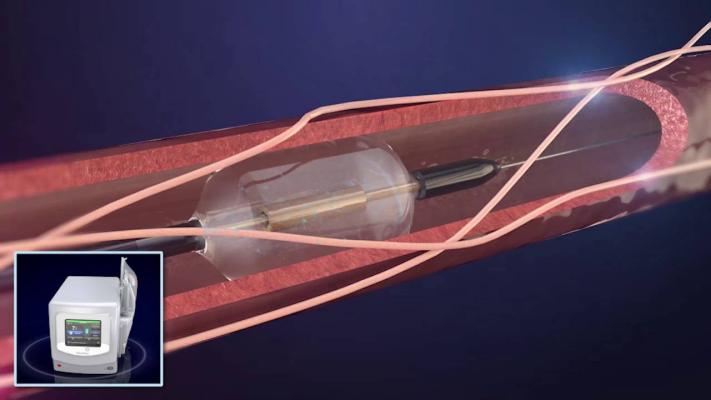 Primary Results from RADIANCE II Trial Published in JAMA and Results of Pooled Analysis from Three RADIANCE Studies Published in JAMA Cardiology 