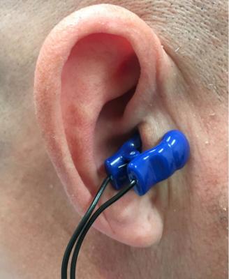 The Parasym Salustim device ear clip stimulates the vagus nerve, which was found to reduced AF burden compared with a sham procedure in the TREAT AF trial. 