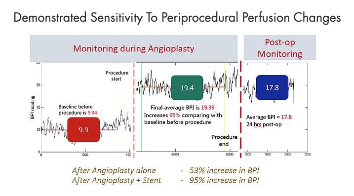 The Pedra Blood Perfusion Index tracks real-time changes in foot tissue perfusion attendant with balloon inflation and deflation during an angioplasty procedure.