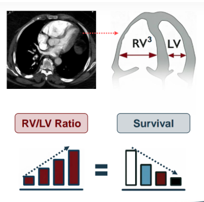 Randomized Controlled Trial: CAVT with Anticoagulation Superior to Traditional Anticoagulation Treatment  