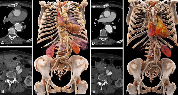 Comparison of image quality between EID CT with standard contrast media protocol and PCD CT with low-volume contrast media protocol using a matched radiation dose. Transverse and three-dimensional cinematic rendered images from thoracoabdominal CTA in a 71-year-old woman in group 2 are shown. (A–C) Images from third-generation EID CT with automated tube voltage selection of 90 kVp. (D–F) Images from PCD CT with reduced contrast media volume of 52.5 mL and VMI at 50 keV. Time interval between scans was 6 mon