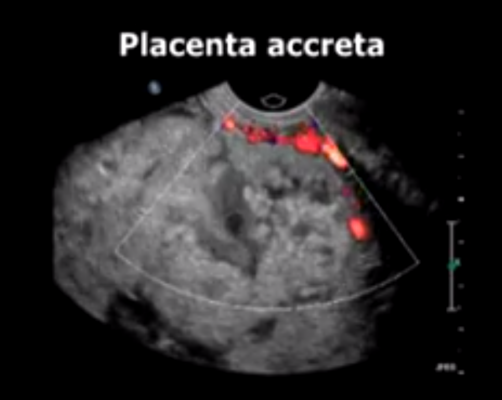 interventional radiology, placenta accreta, RSNA, study