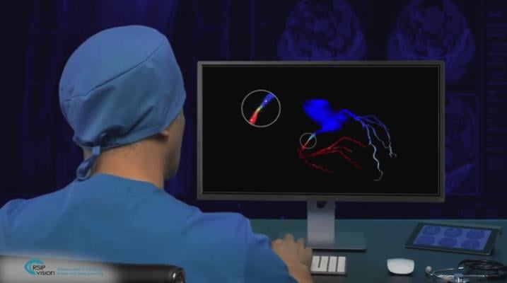 RSIP Vision introduced a new coronary artery modeling technology that enables quick and accurate reconstruction of the coronary vasculature during angiography into a 3D model in the cath lab.