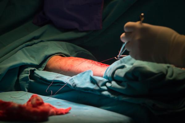 Closing access to the radial artery after harvesting a section of the artery for a coronary artery bypass graft (CABG). Photo by Getty Images. #ACC20 #ACC2020