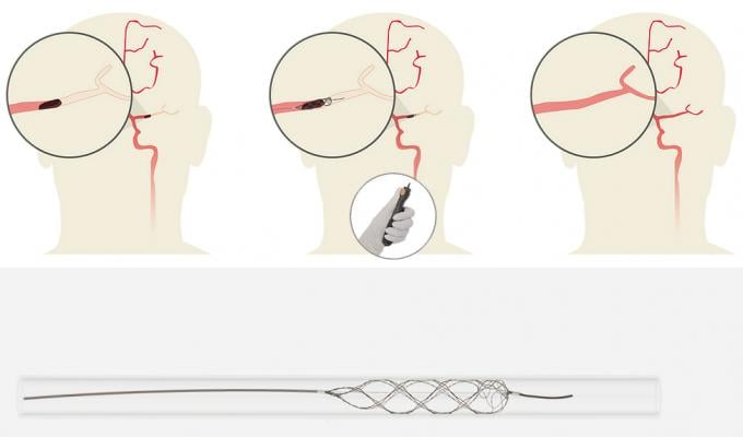 Rapid Medical's TigerTrieve stent-retriever neuro thrombectomy system.