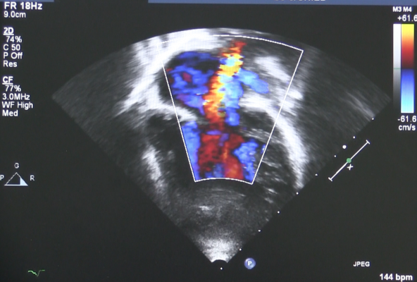 heart valve regurgitation seen on an echocardiogram, cardiac ultrasound, from ASE study