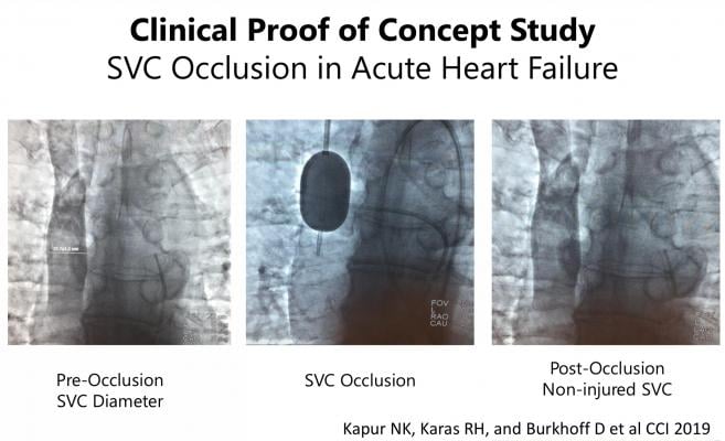 Novel Therapeutic Approach Effective at Reducing Pressure for Heart Failure Patients