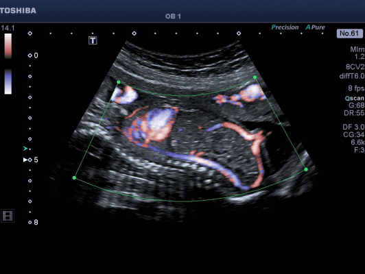 rsna 2013 cardiovascular ultrasound toshiba aplio 500 advanced dynamic flow