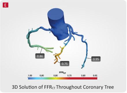 HeartFlow, CT-FFR, computed tomography fractional flow reserve, UH Case Medical