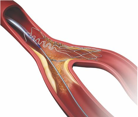 tryton side branch stent, bifurcation stenting, Cardinal Health