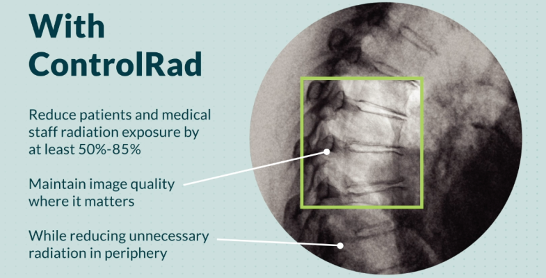 The ControlRad device collimates the area of interest where the physicians are working, and reduces the dose significantly to peripheral areas in the image. 