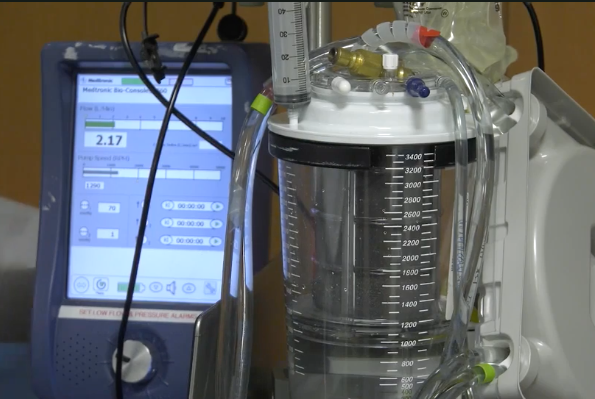 Extracorporeal membrane oxygenation (ECMO) is a lifesaving treatment for critically ill neonates. But there has been little data published on which of these patients are more likely to be readmitted to the hospital later on.