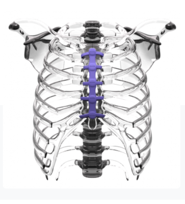Evonik Venture Capital has invested in CircumFix Solutions, a Tennessee-based start-up that has developed a new sternal closure device to improve patient recovery after open chest surgery. The patented orthopedic device, made of a high-performance polymer from Evonik, closes and holds the sternum securely together after surgery. 