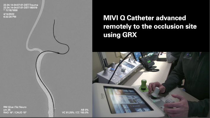 The MIVI Neuroscience Q Aspiration Catheter incorporates a novel pusher wire design on its proximal end. This feature has demonstrated in simulated use studies that the Q Catheter may be uniquely suited to allow physicians in the future to treat ischemic stroke patients remotely via a robot from a different room, a different city, or even a different country. 