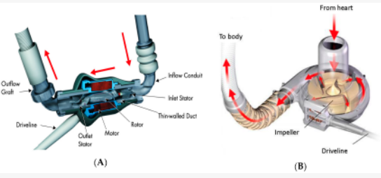 Pump housing and impeller design. (A): (left) Axial flow pump: HeartMate II LVAD (taken from Figure 2 in the HeartMate II left ventricular assist system instructions for use). (B) (right) Centrifugal flow pump: HeartWare assist device (taken from Figure 2 in the HeartWare assist device patient manual).