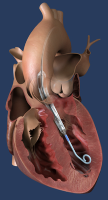 Impella ECP, the world's smallest heart pump, is placed percutaneously into the heart's left ventricle. (Graphic: Business Wire)