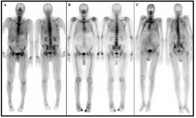 This figure highlights 3 patients with a final diagnosis of low-grade uptake (Perugini grade-1). Endomyocardial biopsy results were available for the patient depicted in Panel B demonstrating ATTR-CA as the underlying pathology. Image created by Department of Nuclear Medicine, Medical University of Vienna, Austria.