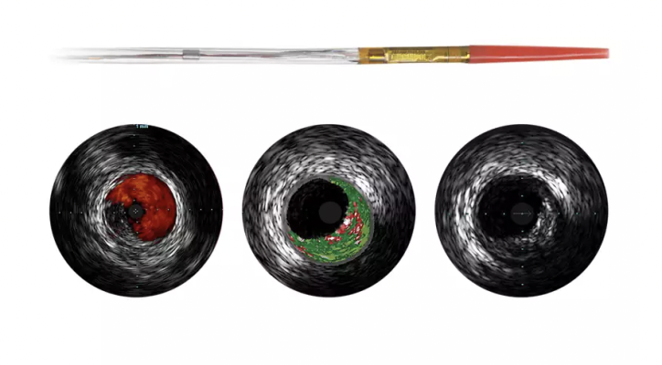 Northeast Scientific Inc., the pioneers in reprocessing single use peripheral vascular catheters, announced this week it has received FDA 510(k) clearance for reprocessing the Philips IVUS Eagle Eye Platinum RX Digital catheter.